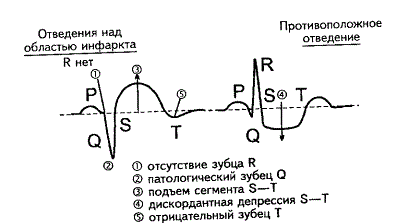 Что такое не g инфаркт миокарда Что такое не g инфаркт миокарда