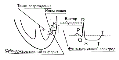 Мелкоочаговый инфаркт