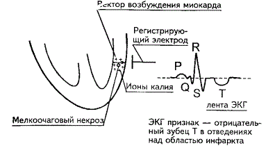интрамуральный инфаркт