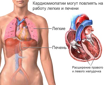 Гипертрофическая кардиомиопатия симптомы и признаки Гипертрофическая кардиомиопатия лечение Гипертрофическая кардиомиопатия симптомы и признаки Гипертрофическая кардиомиопатия лечение